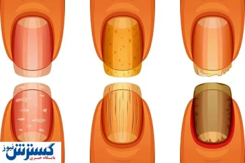 تشخیص سرطان ریه از روی ناخن ممکن شد
